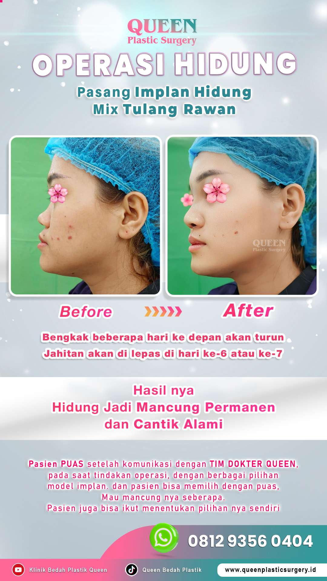 Before-After-OP-Hidung-Mancung-Permanen-dan-Cantik-Alami-02-fotor-2024052415420
