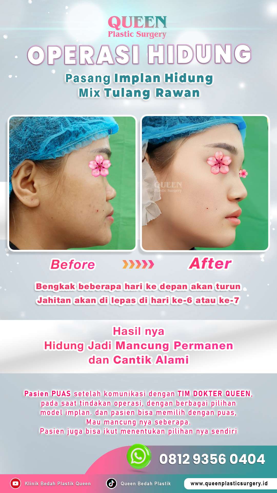 Before-After-OP-Hidung-Mancung-Permanen-dan-Cantik-Alami-fotor-2024052415432