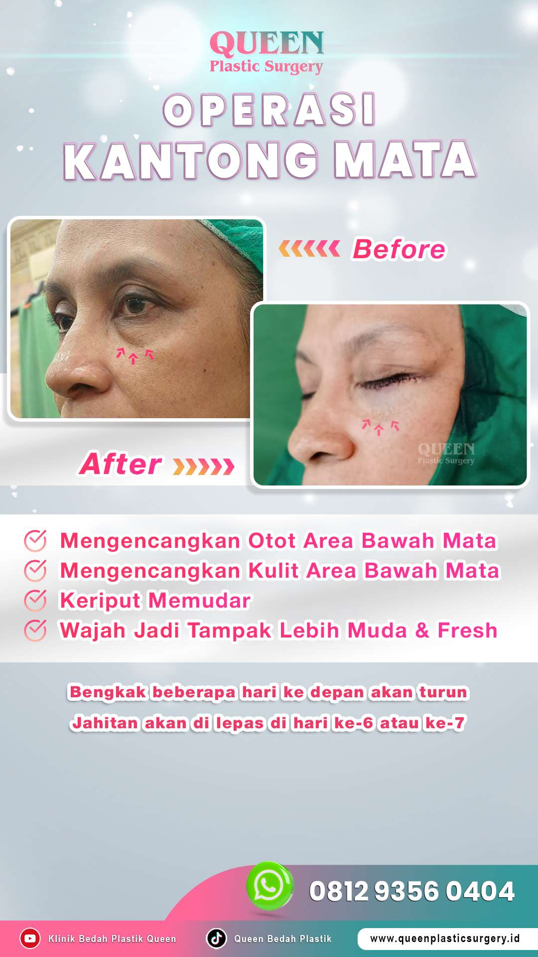 Before-After-OP-Kantong-Mata-02-
