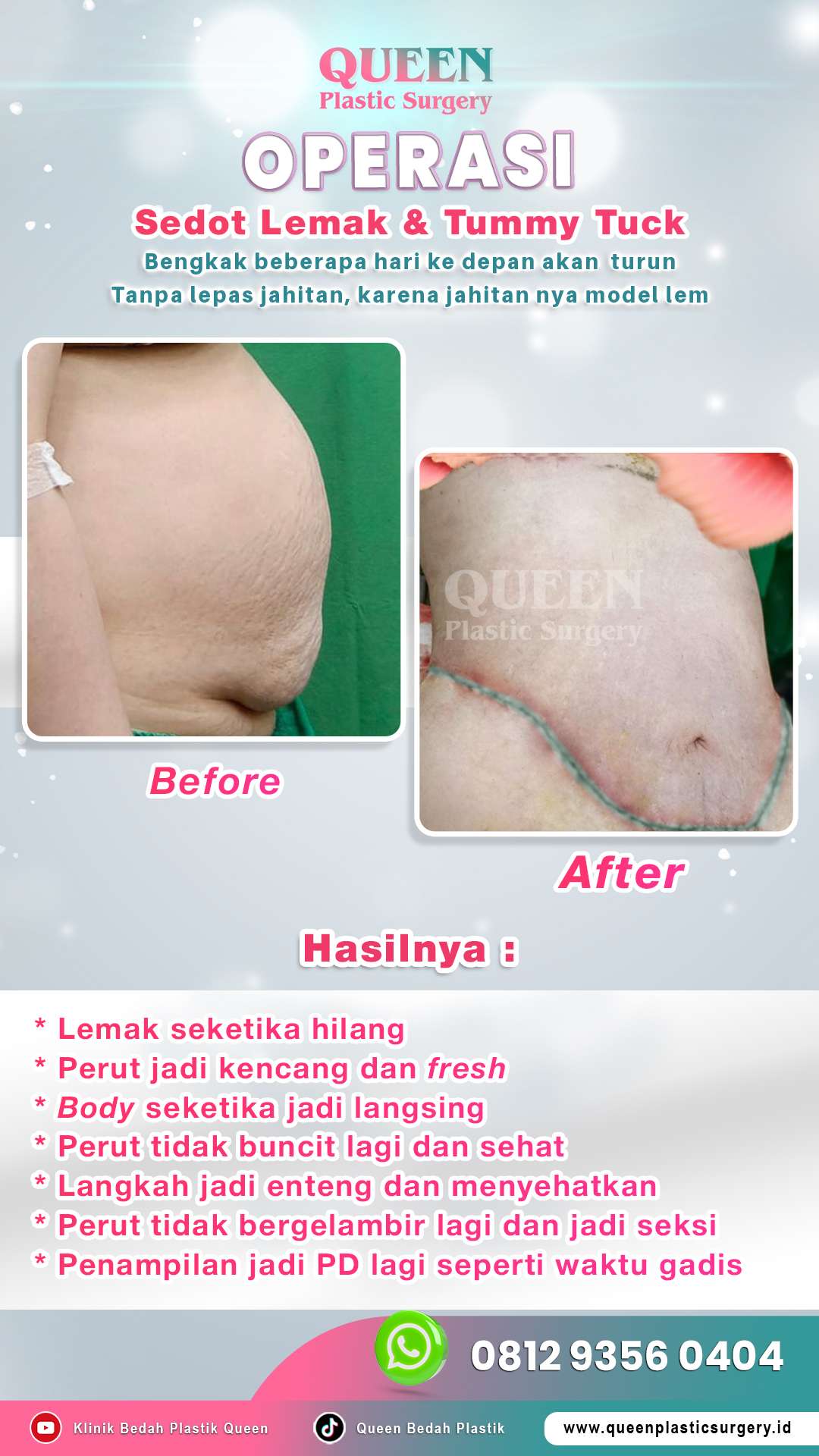 Before-After-OP-Liposuction-&-Tummy-Tuck-02-fotor-2024052217850