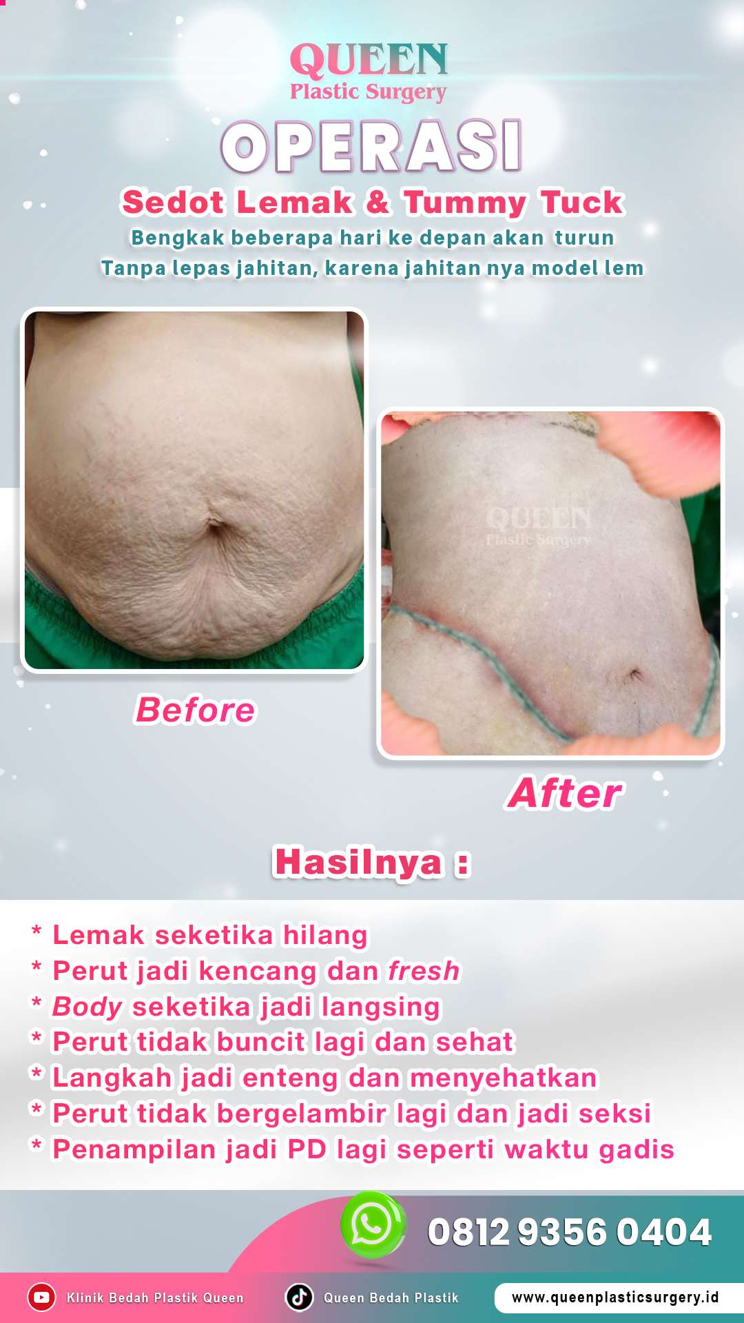 Before-After-OP-Liposuction-&-Tummy-Tuck-fotor-2024052217915