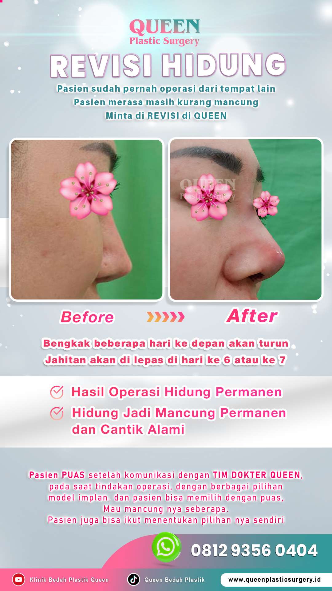 Before-After-OP-Revisi-Hidung-fotor-202405221797