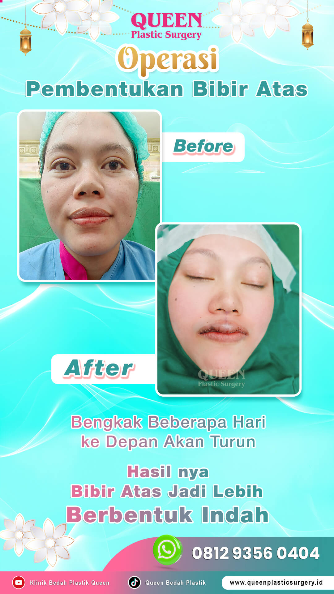 Before-After-Operasi-Bibir-Atas-Queen (1) Before-After-Operasi-Bibir-Atas-Queen (1)