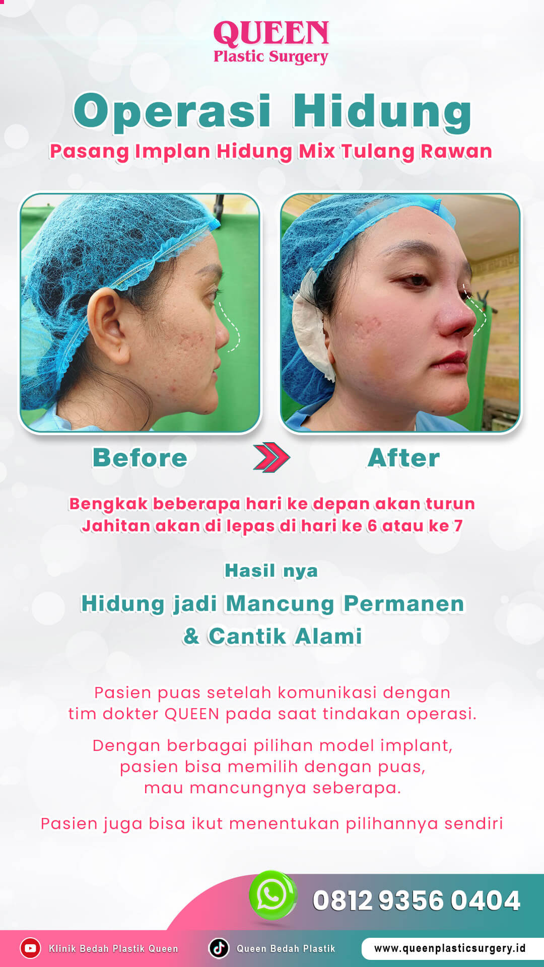 Before-After-Operasi-Hidung-002 (1)