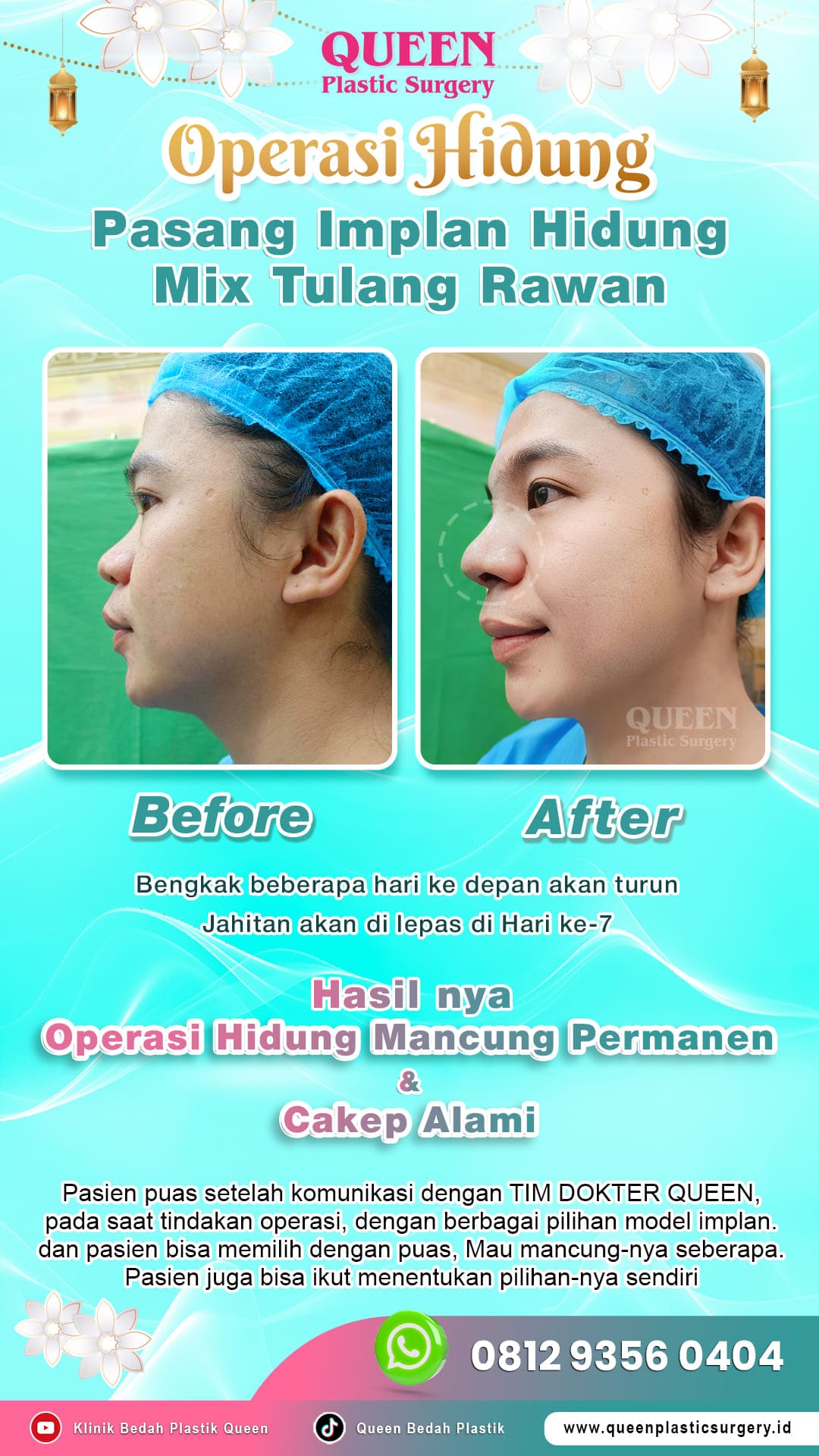 Before-After-Operasi-Hidung-Queen-001