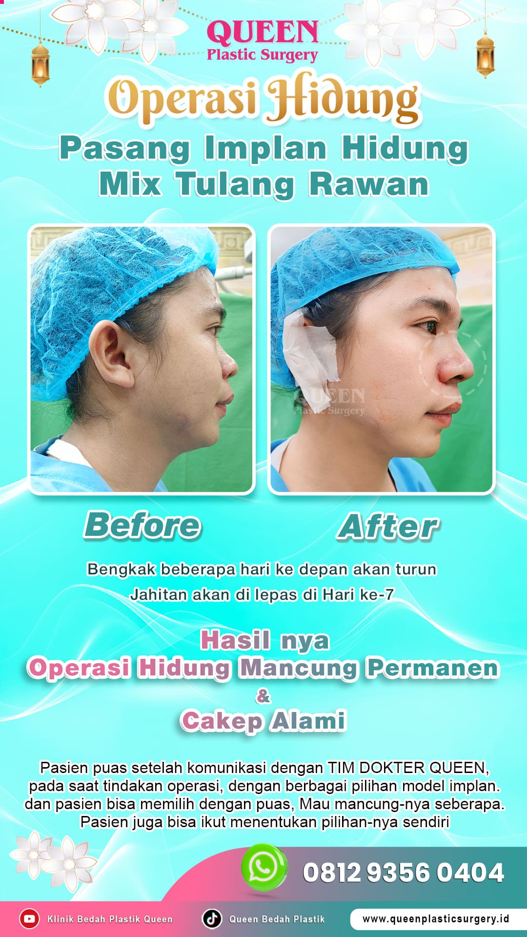 Before-After-Operasi-Hidung-Queen-002