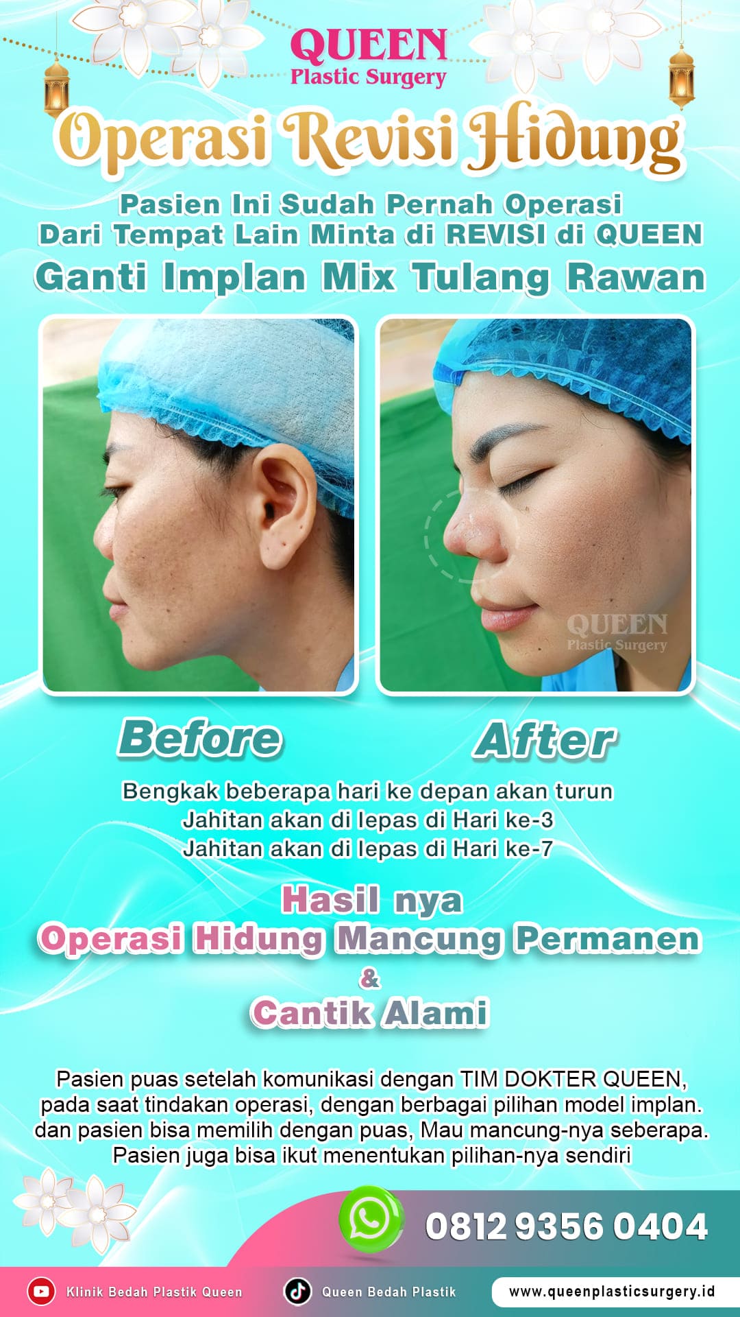 Before-After-Operasi-Revisi-Hidung-Queen-001