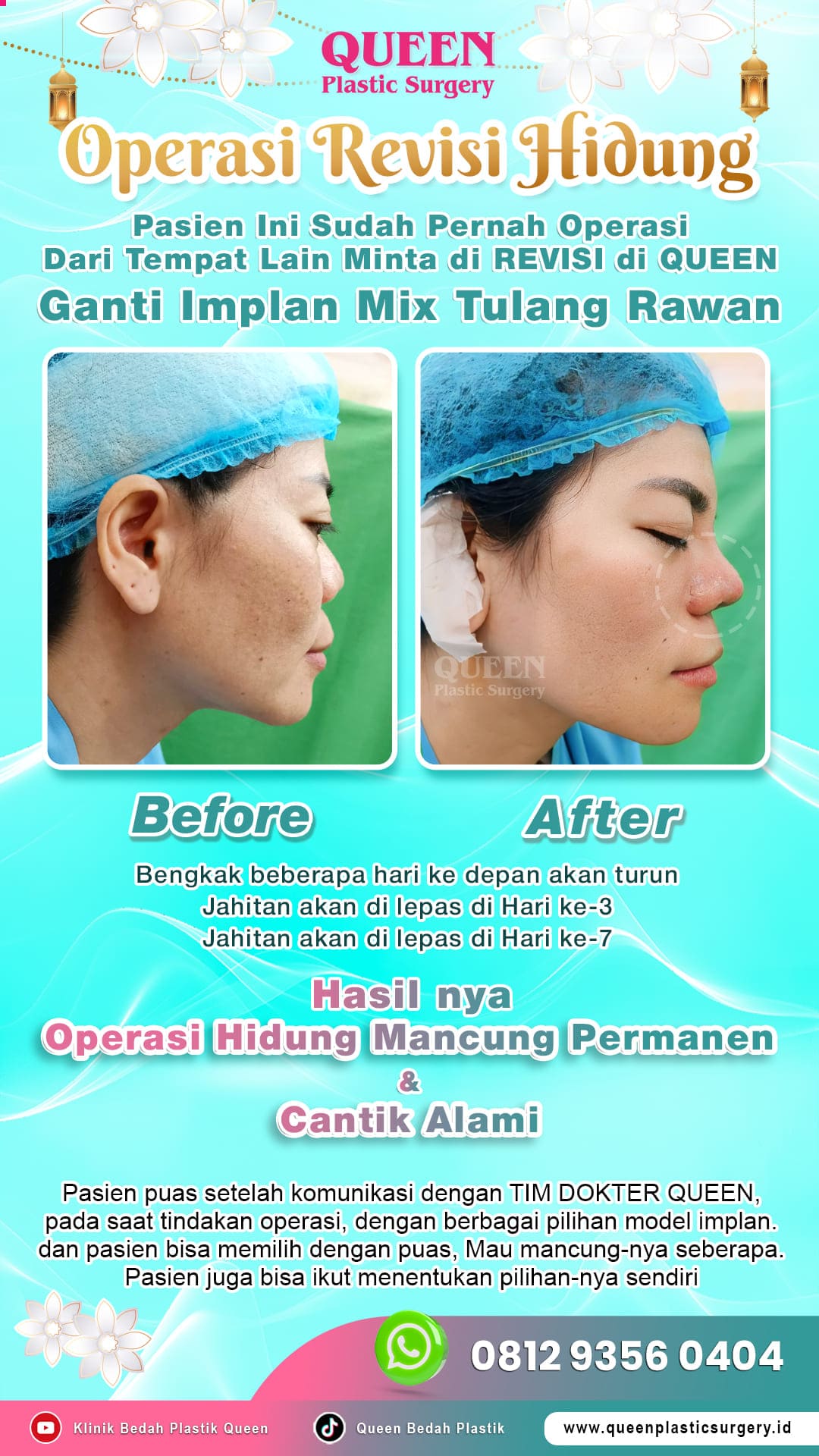 Before-After-Operasi-Revisi-Hidung-Queen-002