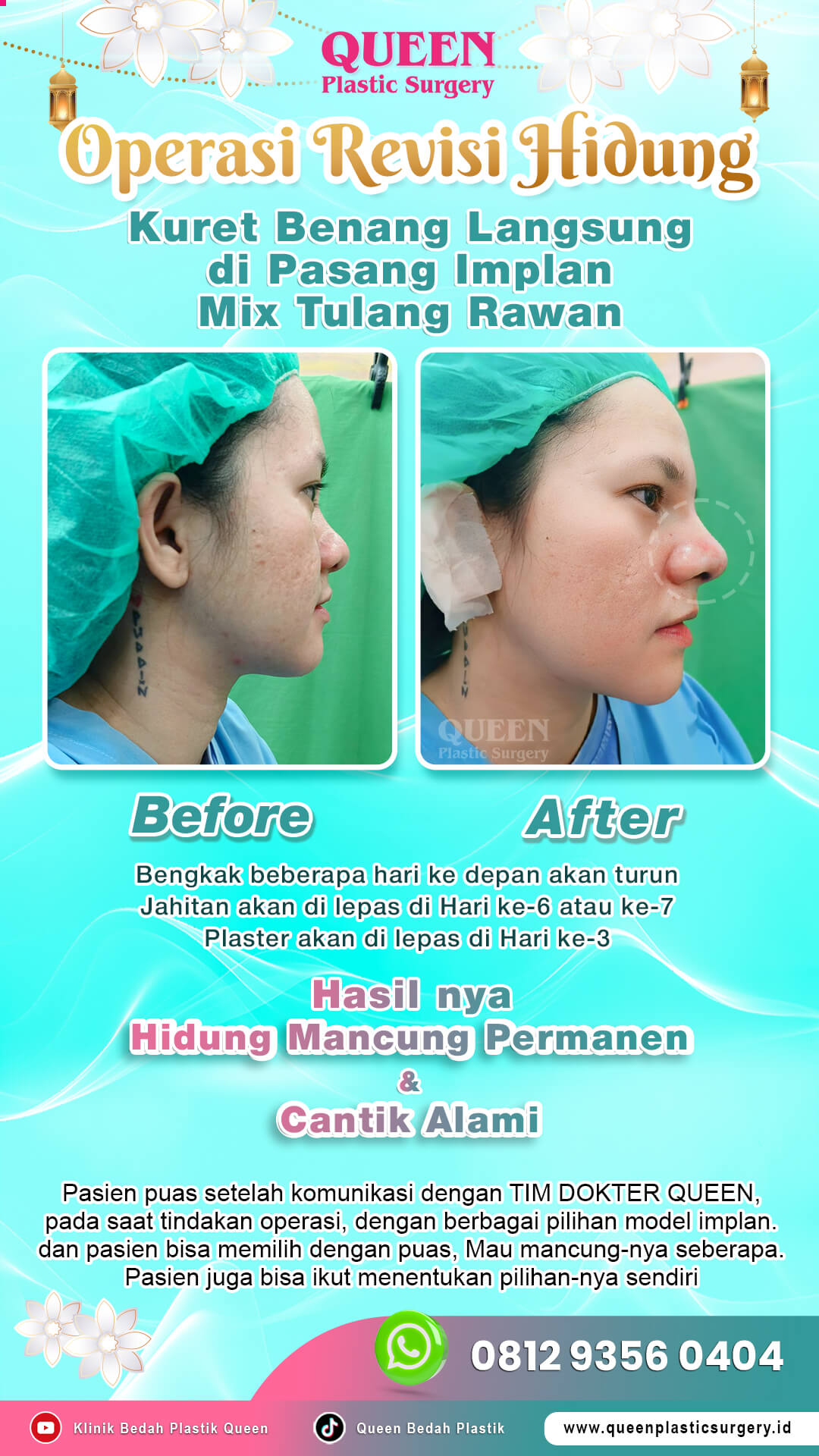 Before-After-Operasi-Revisi-Hidung-Queen-004 (1)