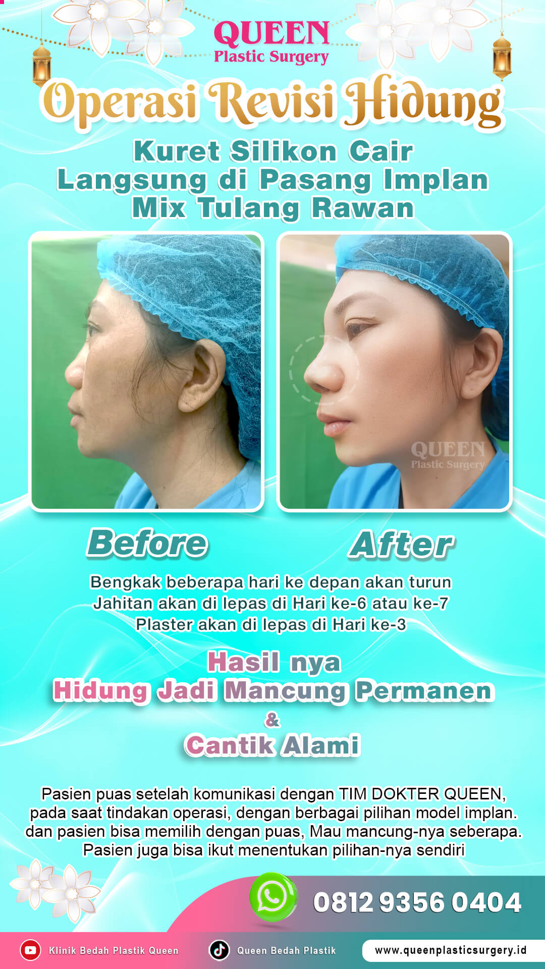 Before-After-Operasi-Revisi-Hidung-Queen-005 (1)