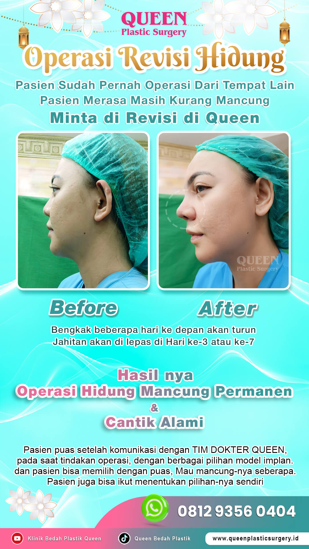 Before-After-Operasi-Revisi-Hidung-Queen-01 (1)