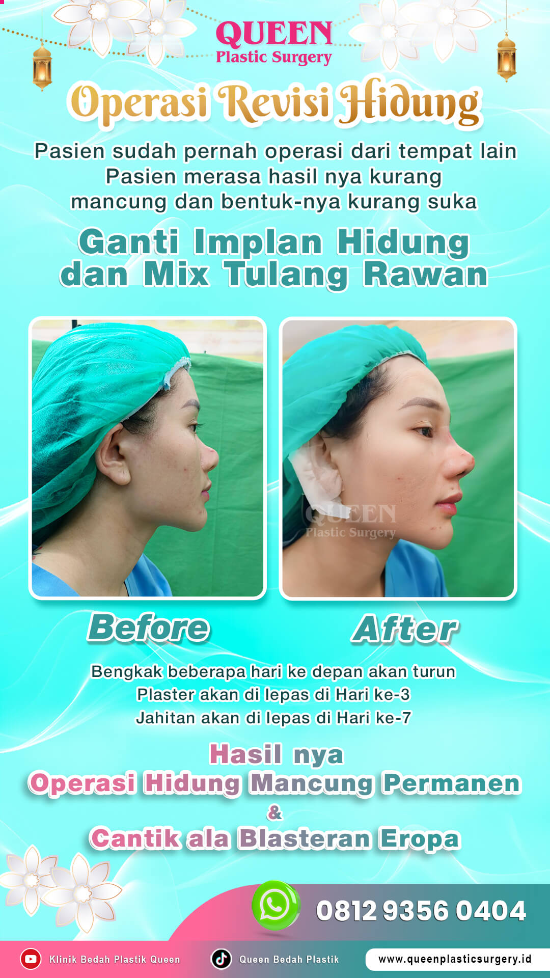 Before-After-Operasi-Revisi-Hidung-Queen-02 (1)