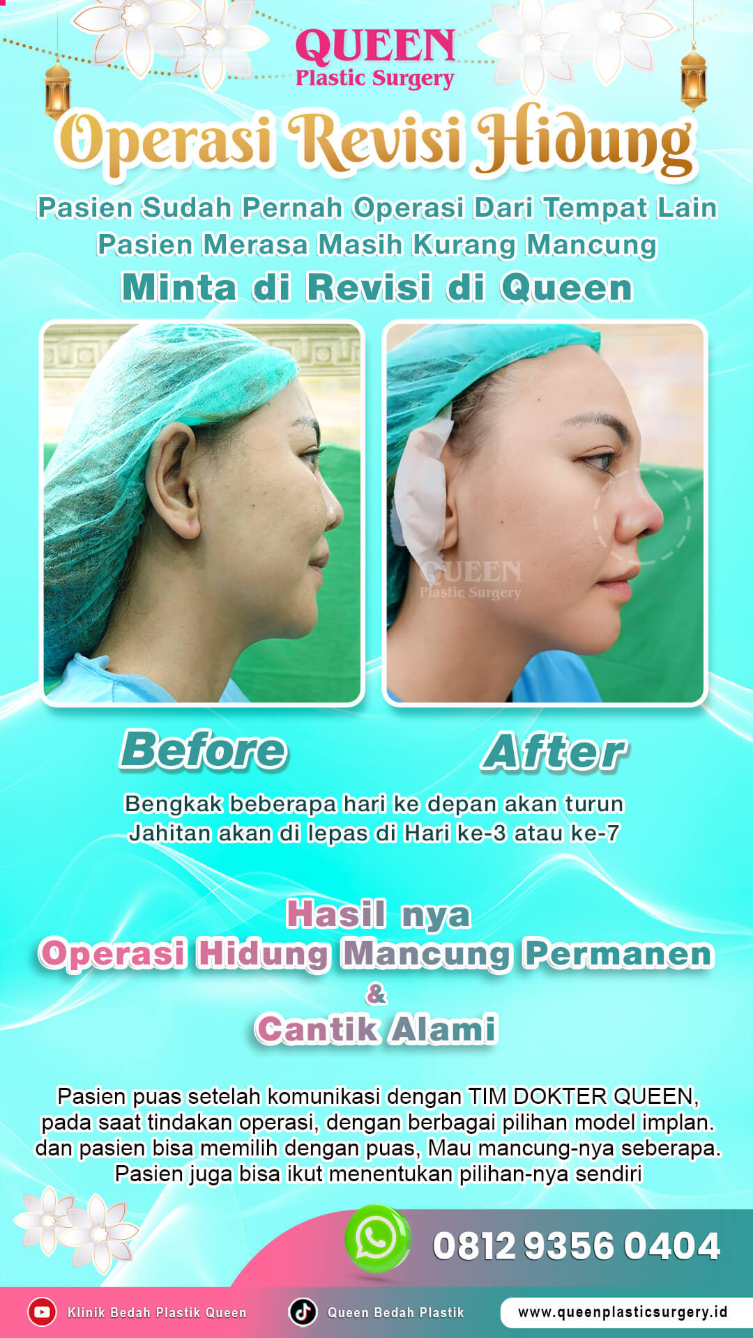 Before-After-Operasi-Revisi-Hidung-Queen-02 (2)