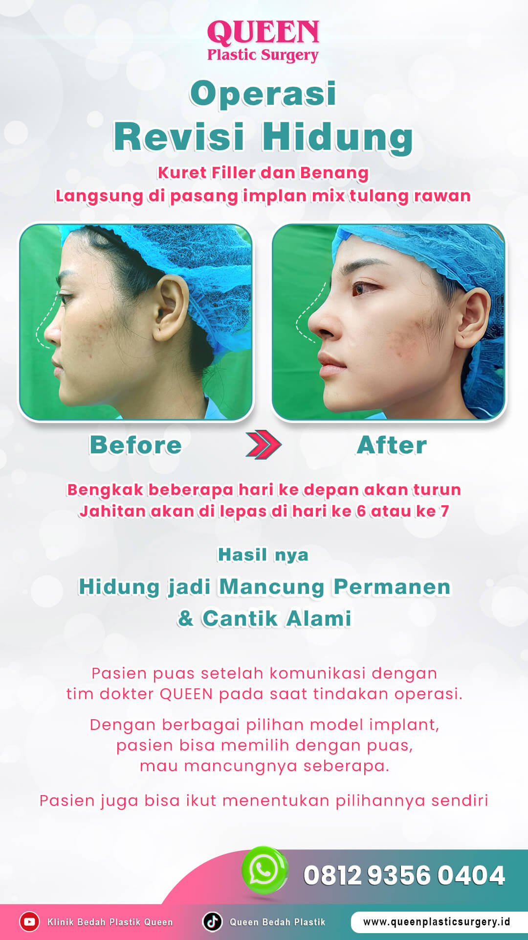 Before-After-Revisi-Hidung-002 (1)