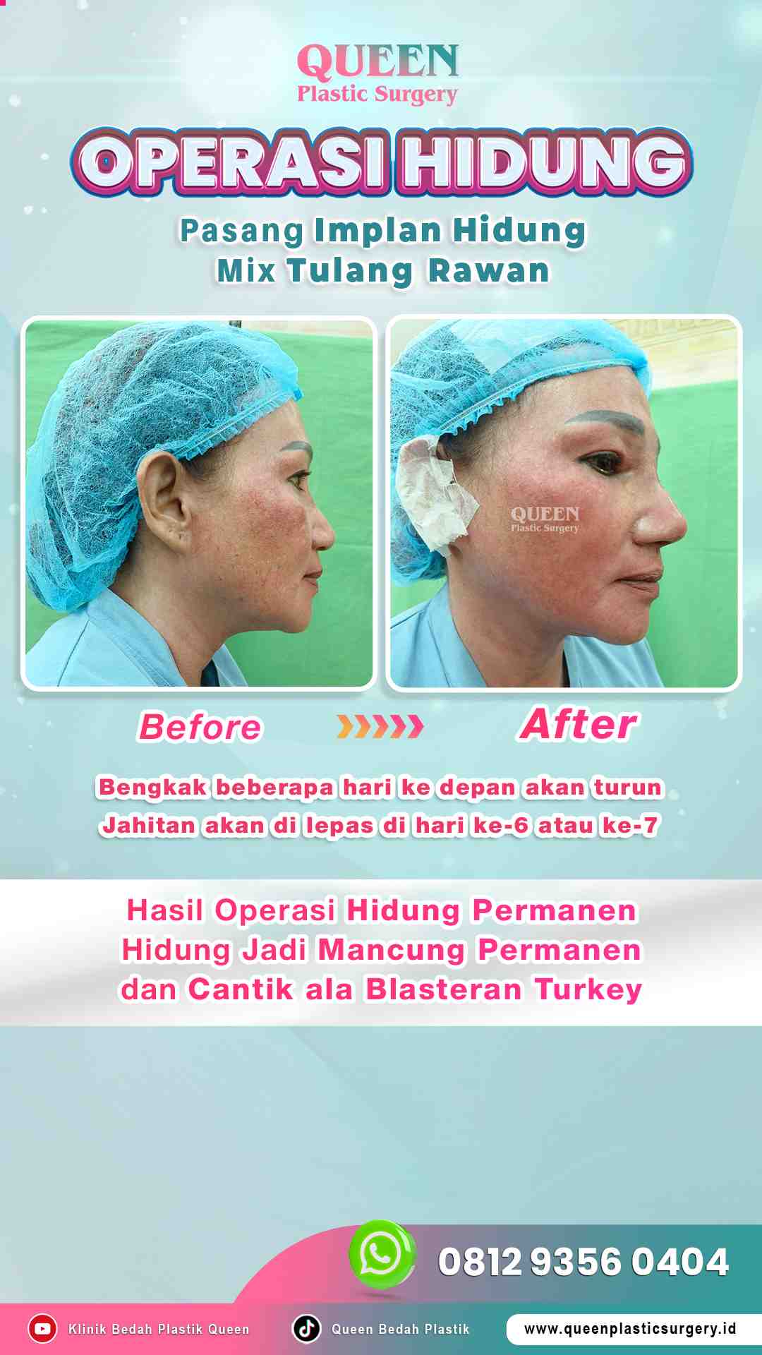 Before_After_OP_Hidung_Mancung_Permanen_dan_Cantik_Ala_Blasteran-