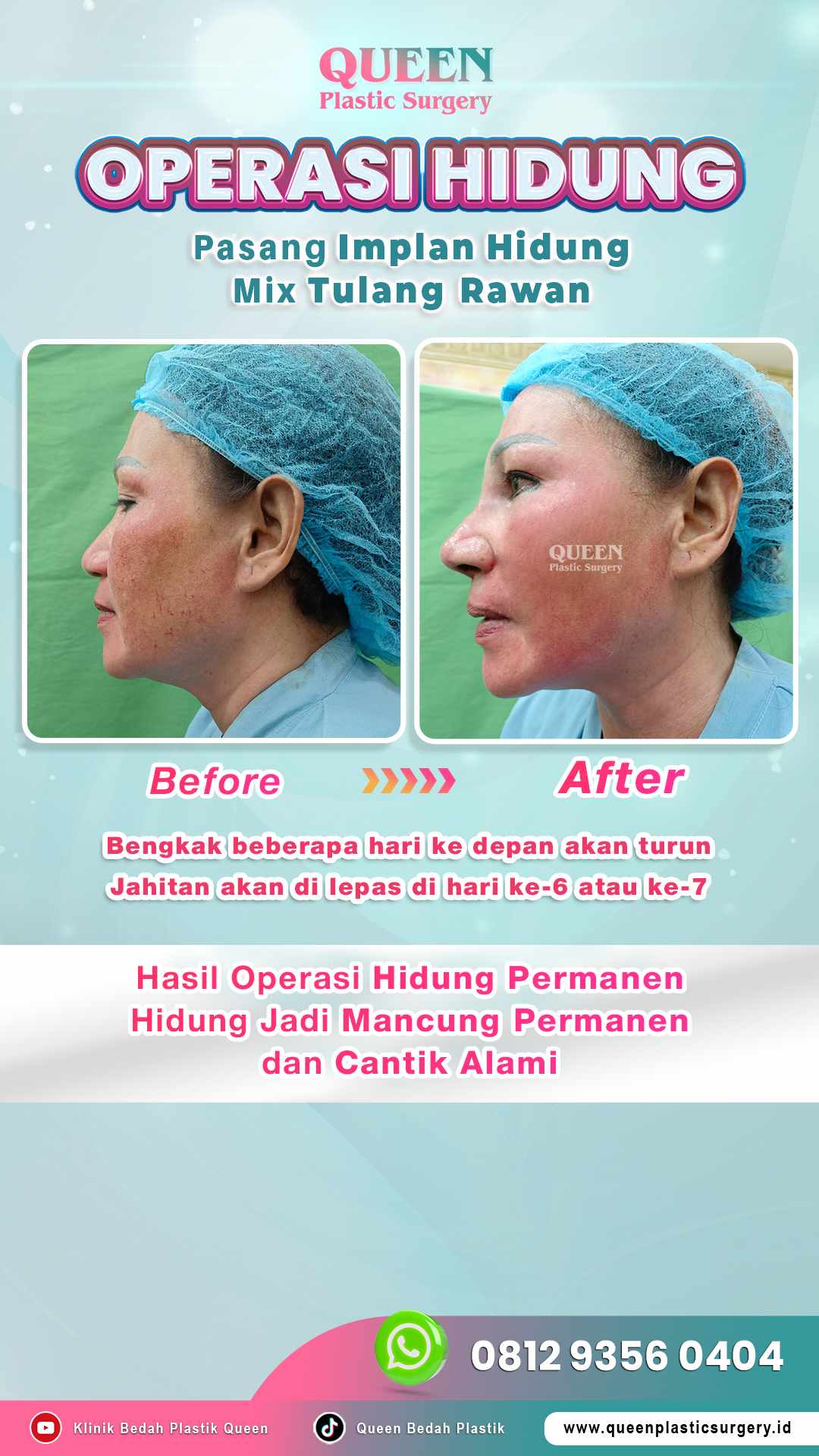 Before_After_OP_Hidung_Mancung_Permanen_dan_Cantik_Ala_Blasteran003-fotor-20240628111417