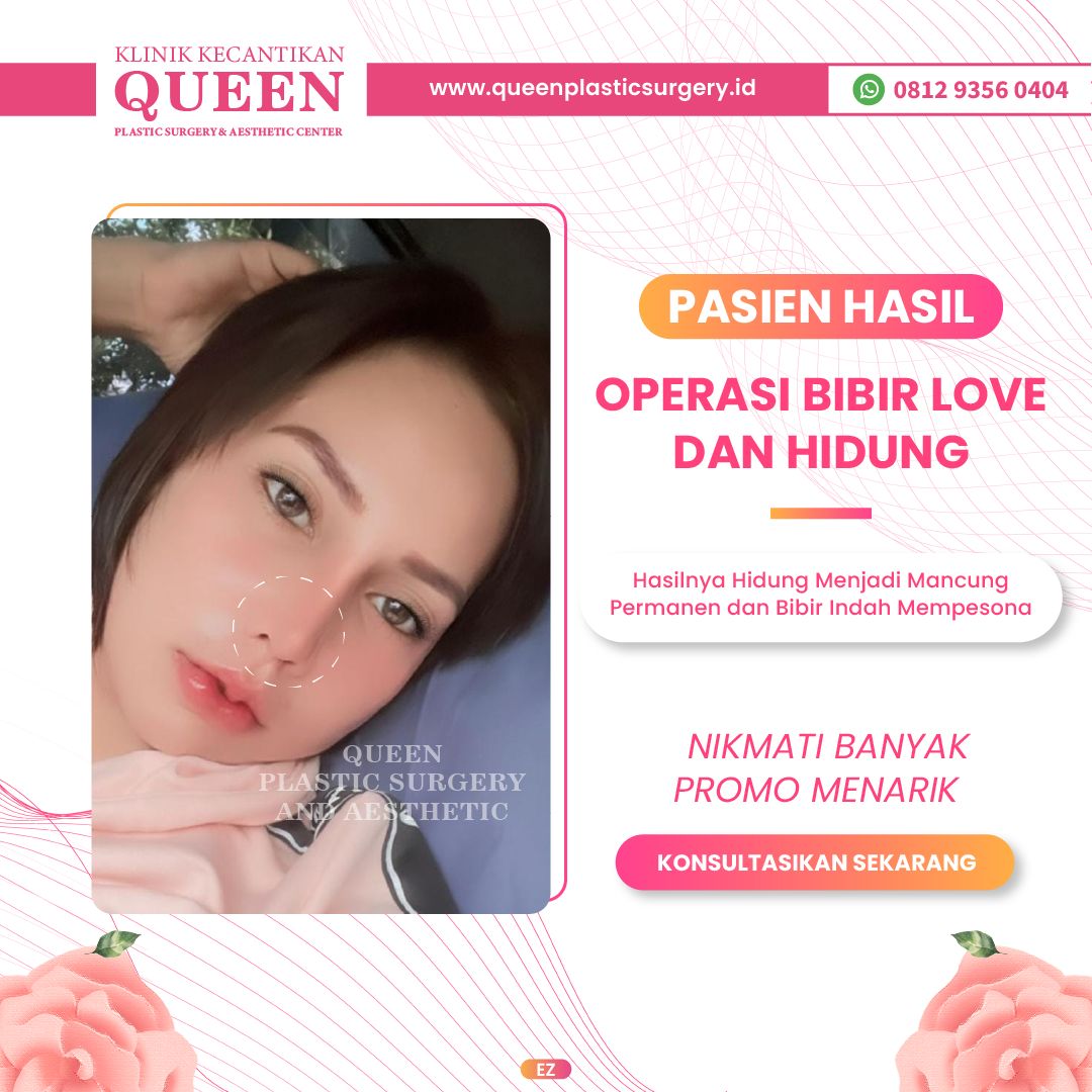 Bagaimana Cara Mengatasi Bibir yang Terlalu Besar Akibat Suntikan Silikon?
