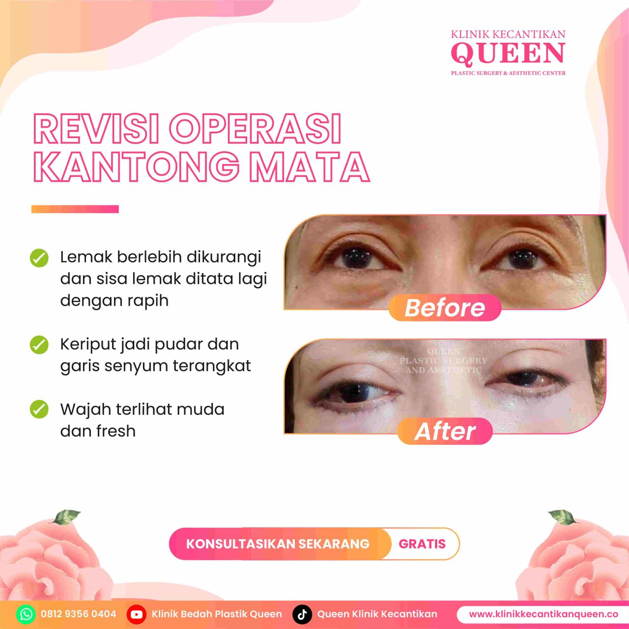 Alkohol dan Operasi Plastik: Bagaimana Kebiasaan Minum Anda Mempengaruhi Pemulihan?