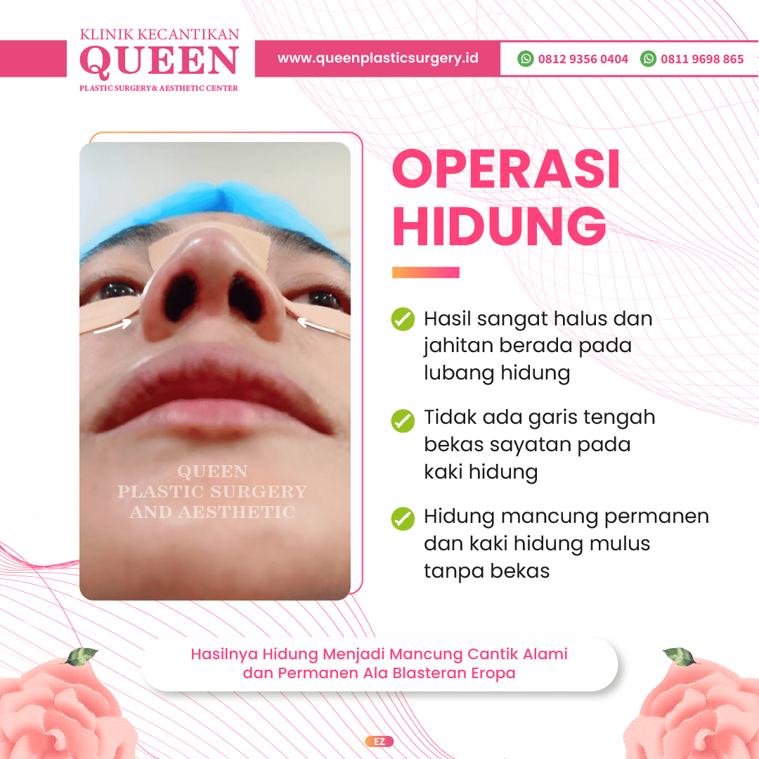 Hasil Rhinoplasty Queen Plastic Surgery, foto 66