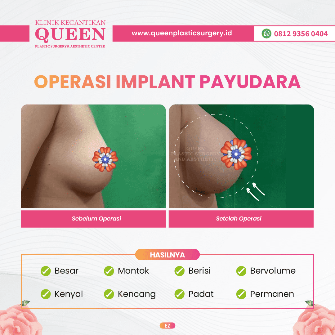 Augmentasi vs Implan Payudara: Apa Saja Perbedaannya yang Harus Anda Tahu?