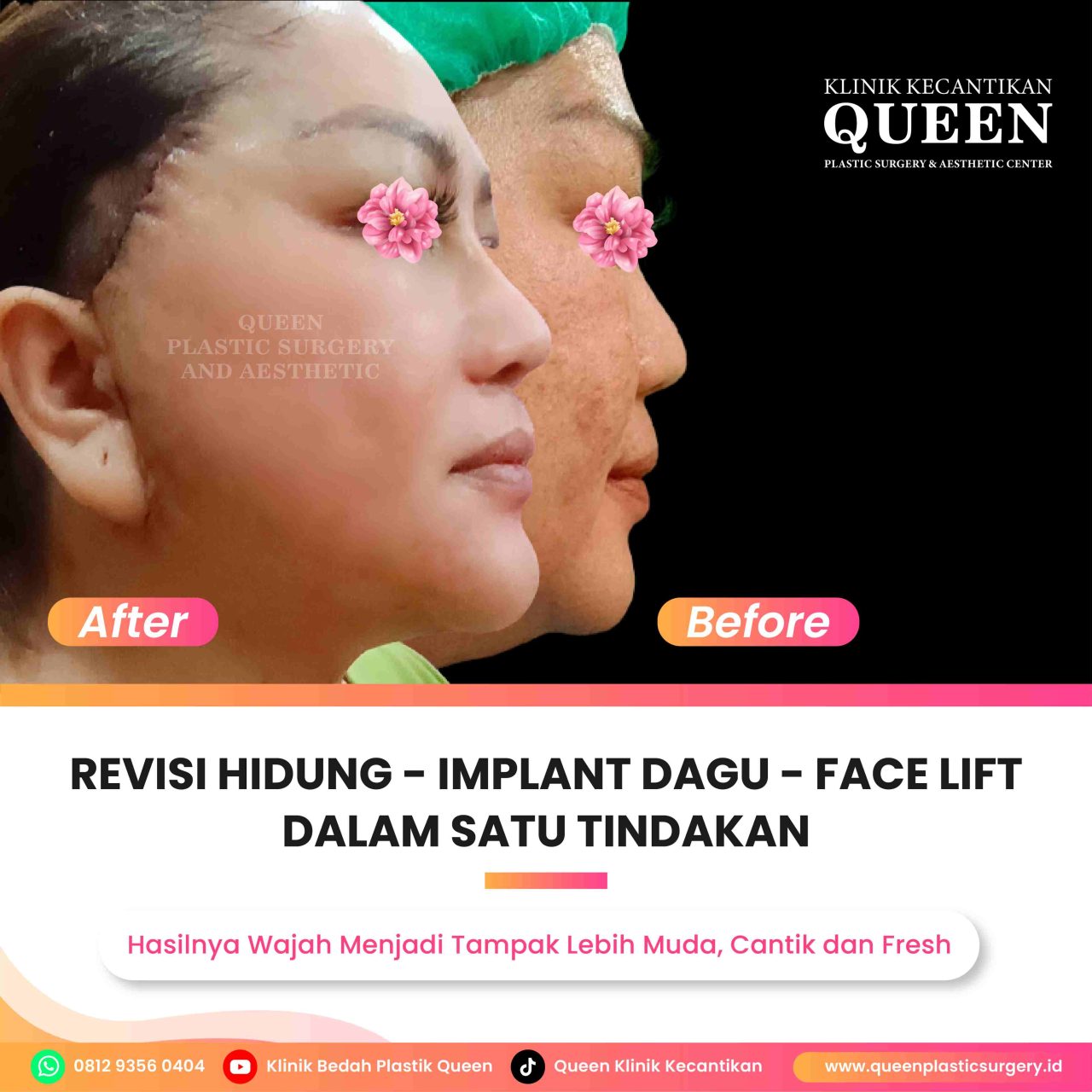 Hasil Rhinoplasty Queen Plastic Surgery, foto 79
