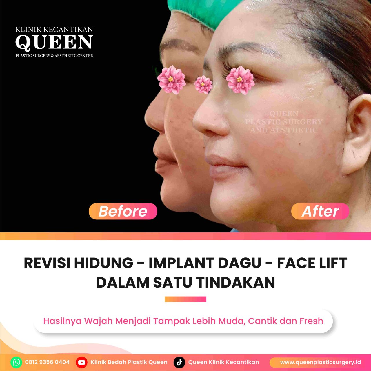 Hasil Rhinoplasty Queen Plastic Surgery, foto 69