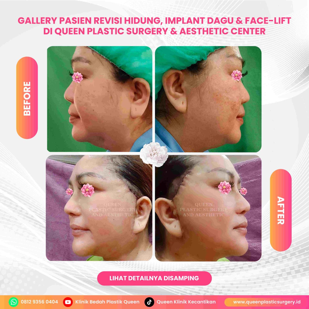 Hasil Rhinoplasty Queen Plastic Surgery, foto 73