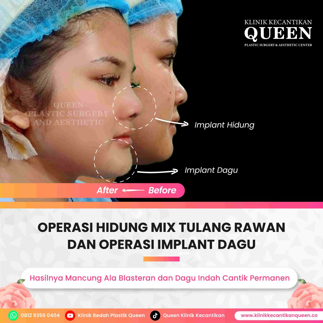 Rhinoplasty dan Dampaknya pada Suara: Bagaimana Operasi Memengaruhi Suara Anda?