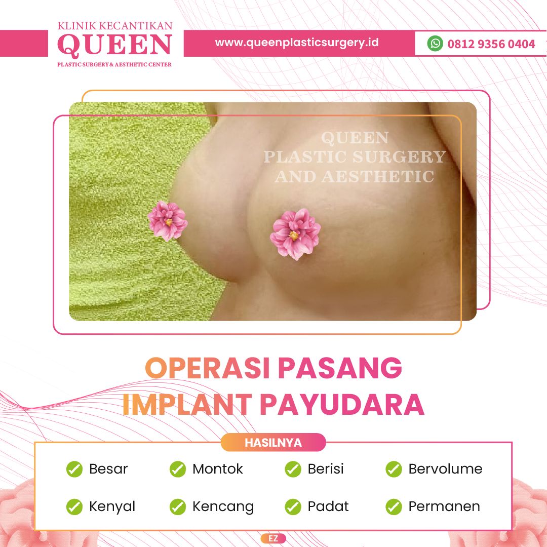 Hasil Breast Implant Queen Plastic Surgery, foto 50