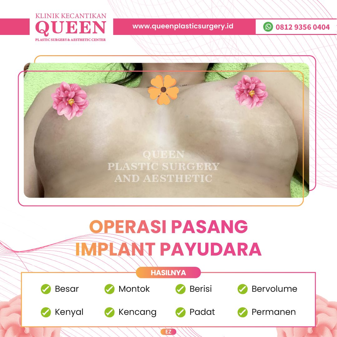 Hasil Breast Implant Queen Plastic Surgery, foto 48