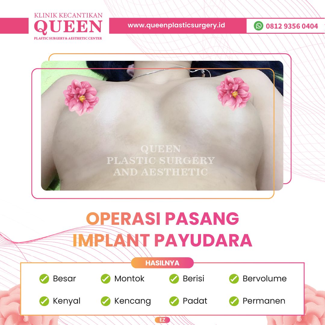 Hasil Breast Implant Queen Plastic Surgery, foto 46