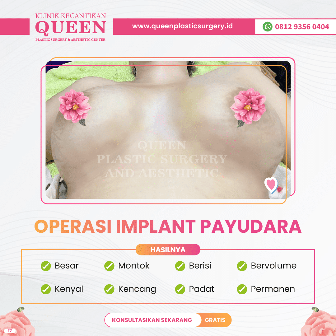 Hasil Breast Implant Queen Plastic Surgery, foto 47