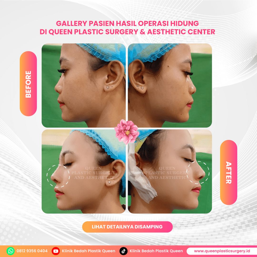 Hasil Rhinoplasty Queen Plastic Surgery, foto 59