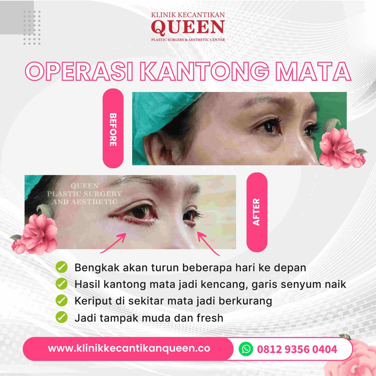 Alkohol dan Operasi Plastik: Bagaimana Kebiasaan Minum Anda Mempengaruhi Pemulihan?