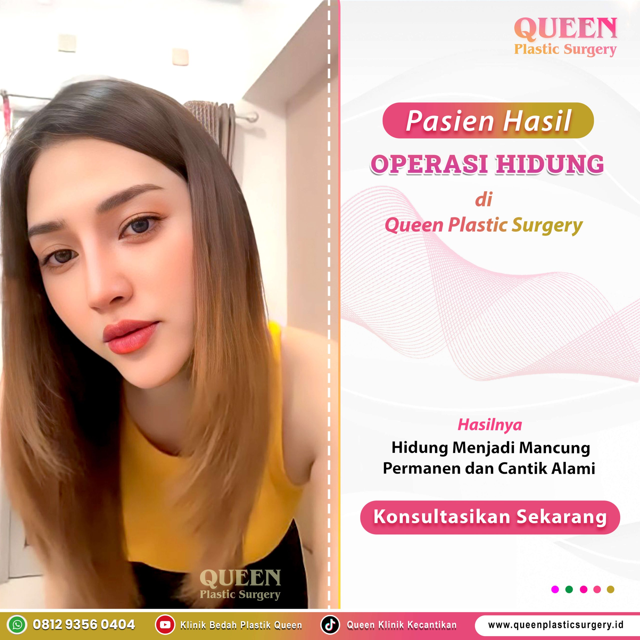 Hasil-Operasi-Hidung-Pasien-Queen-01