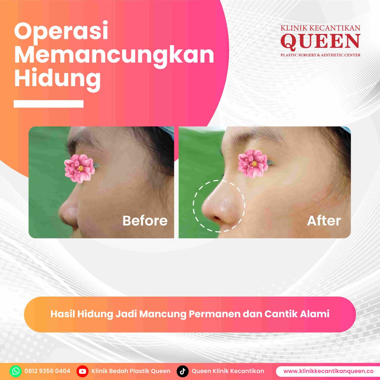 Hidung Pasien 1 (2)-fotor-20240629163054