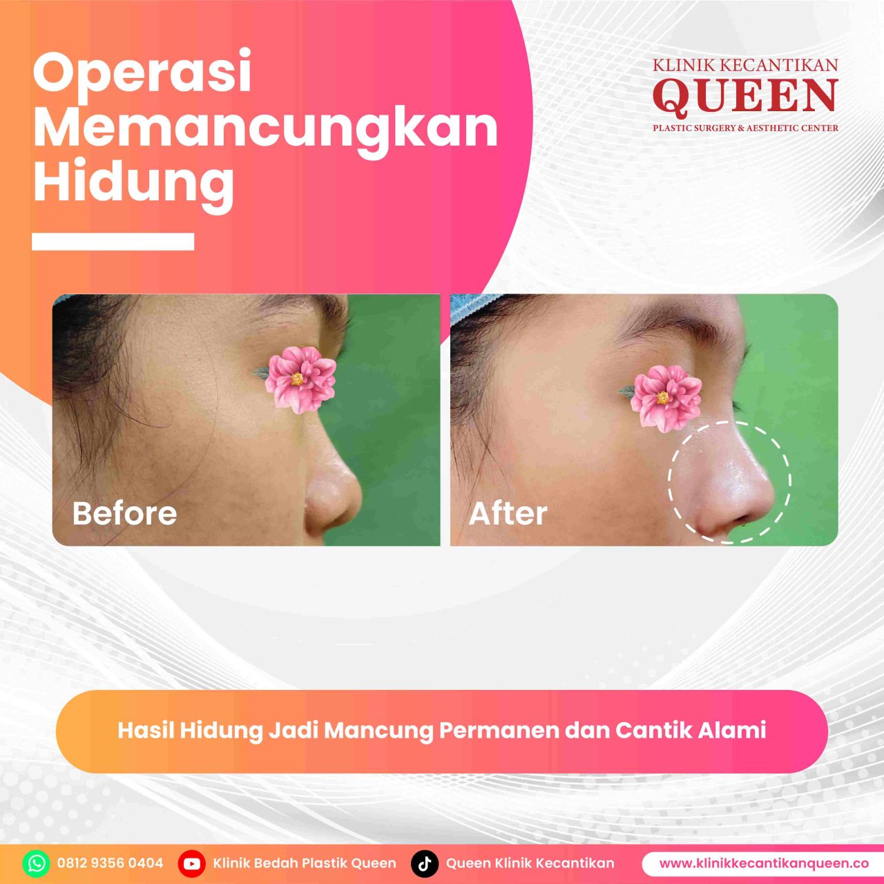 Hidung Pasien 1-fotor-20240628213333
