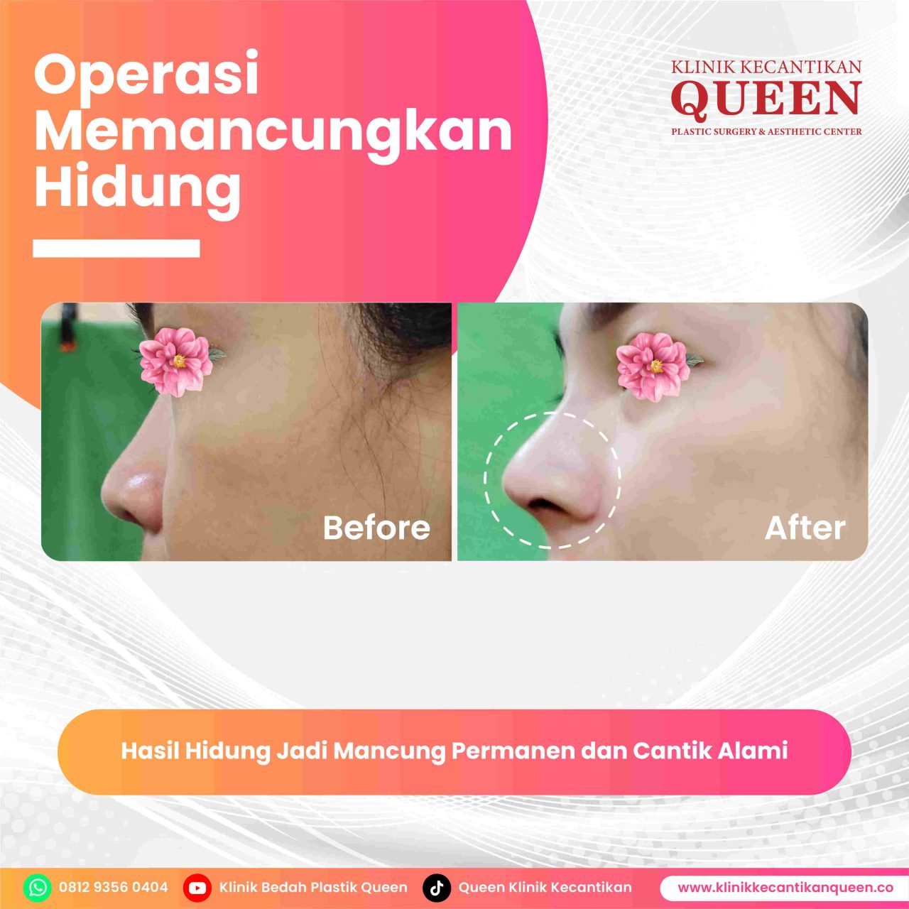 Hidung Pasien 2-fotor-20240629171016