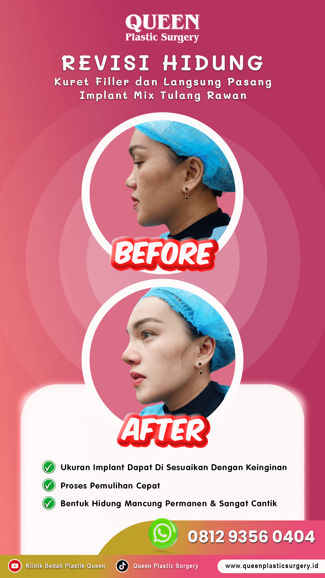 IGS-Rev-Hidung-001
