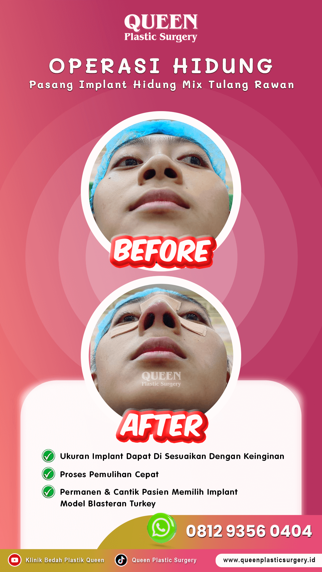 IGS-Rev-Hidung-005
