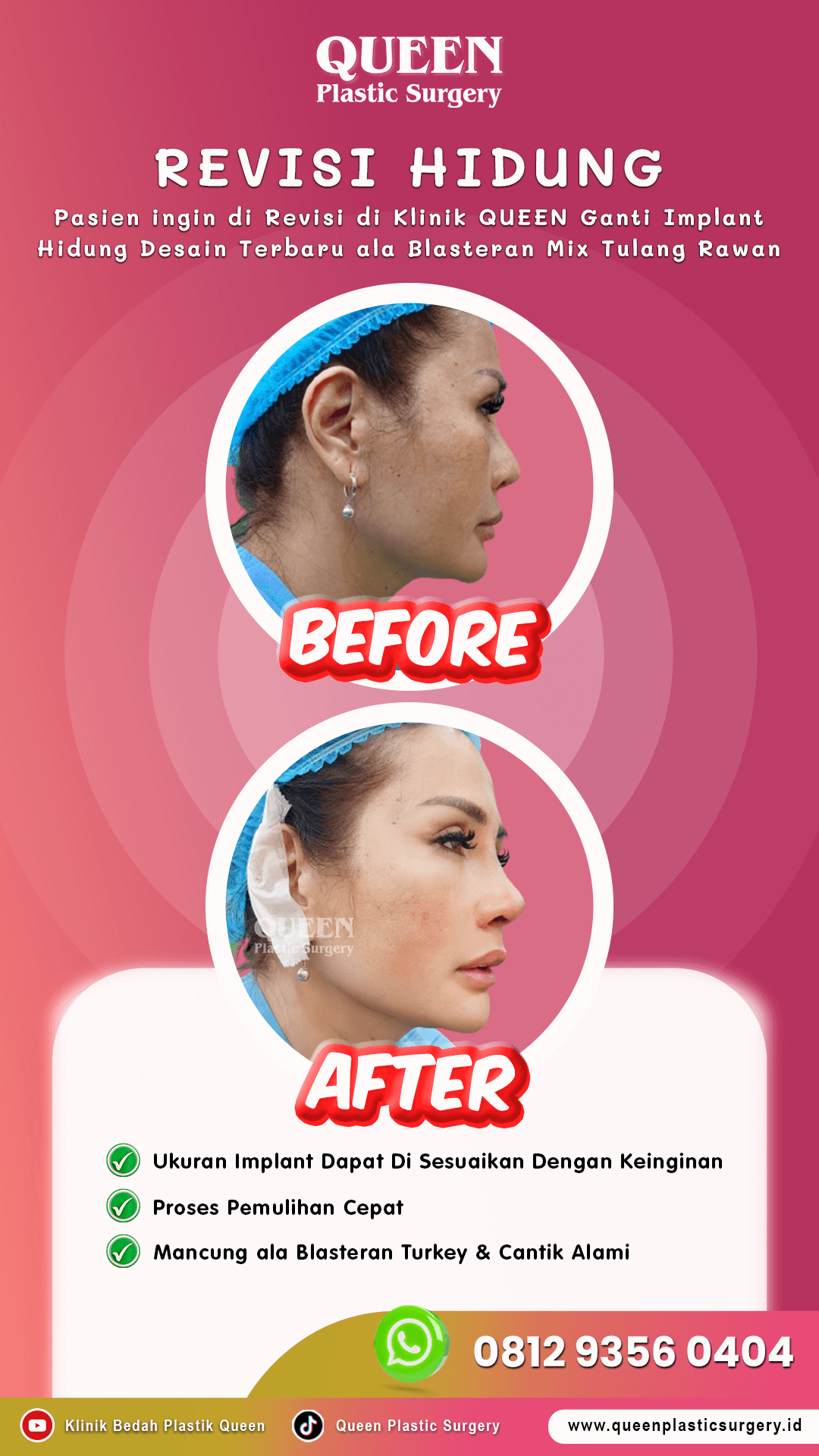 IGS-Rev-Hidung-006
