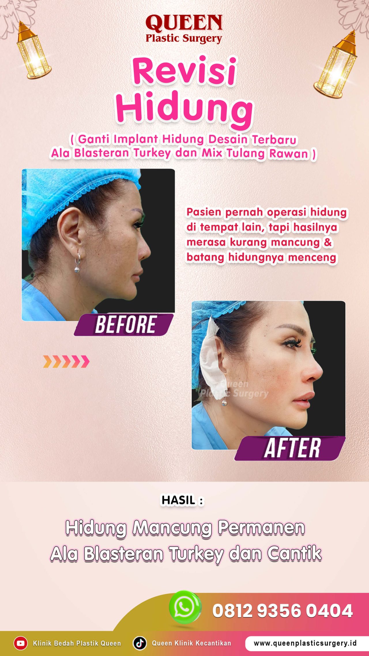 New-Revisi-Hidung-010