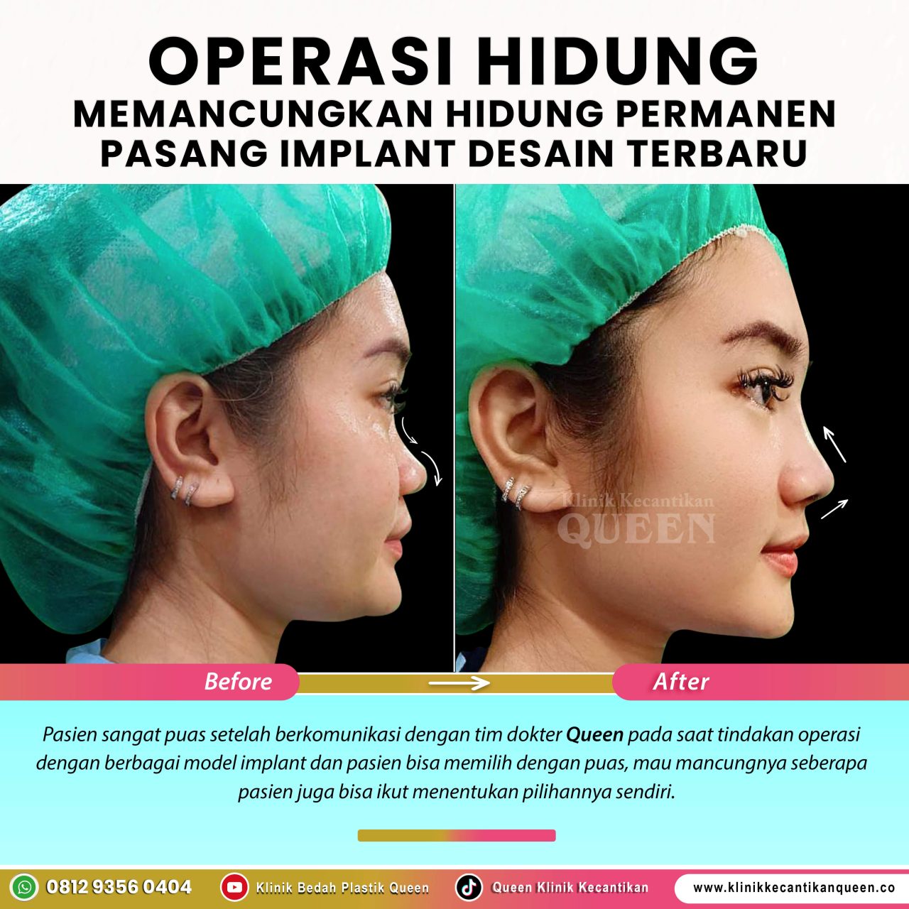 OP-Hidung-IG-Feed-New01