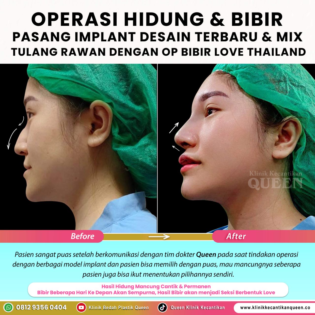 OP-Hidung-IG-Feed-New11