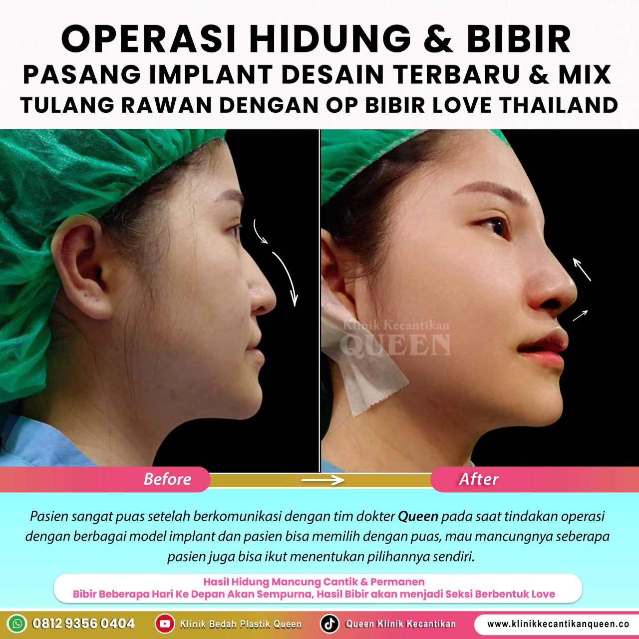 OP-Hidung-IG-Feed-New12