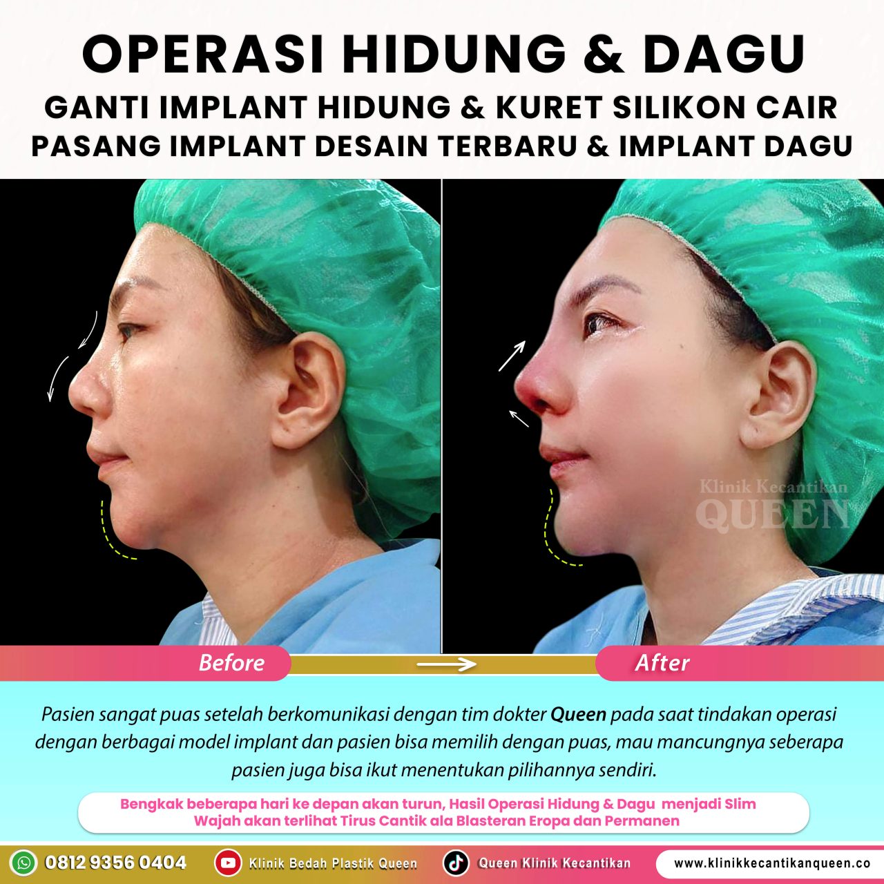 OP-Hidung-IG-Feed-New13