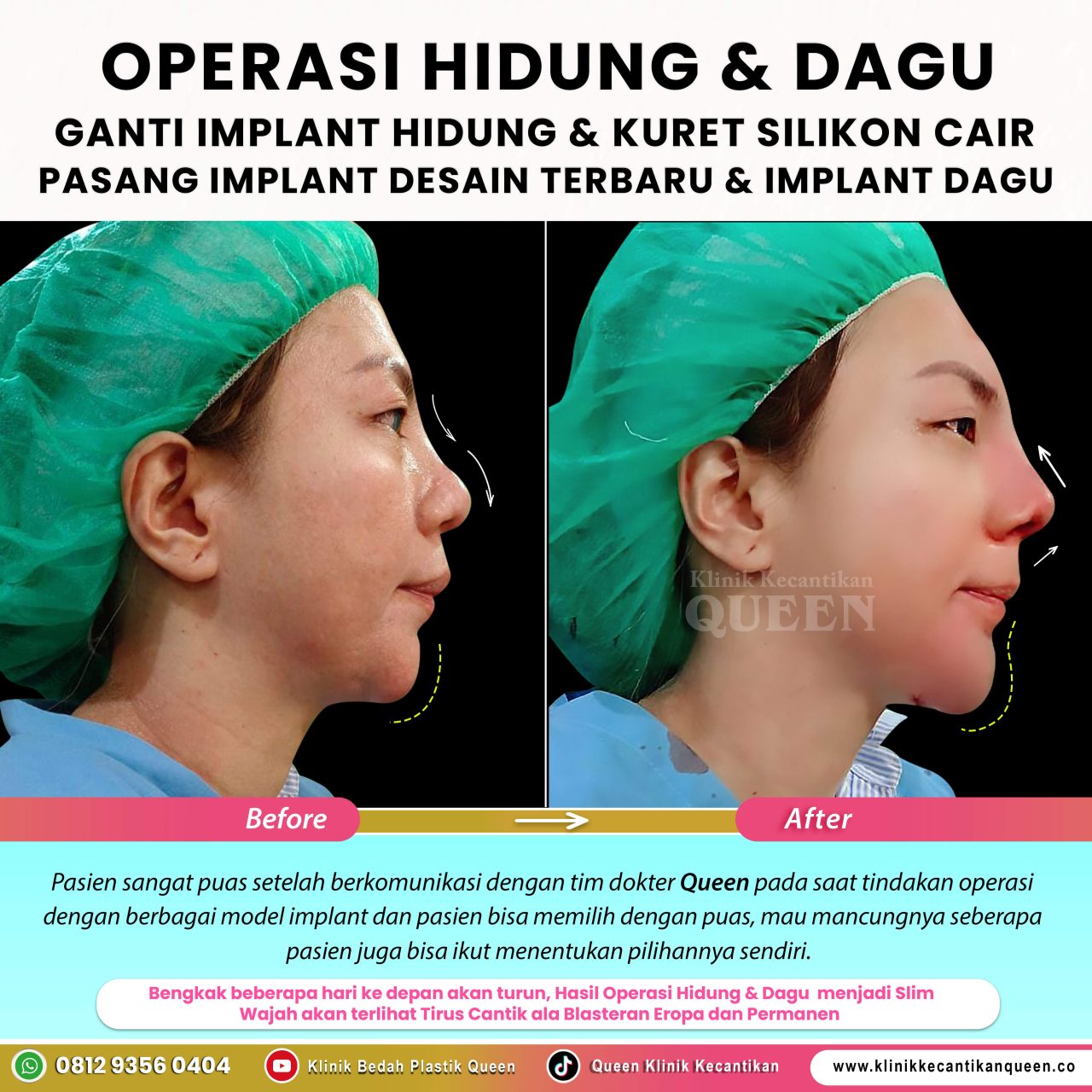 OP-Hidung-IG-Feed-New14
