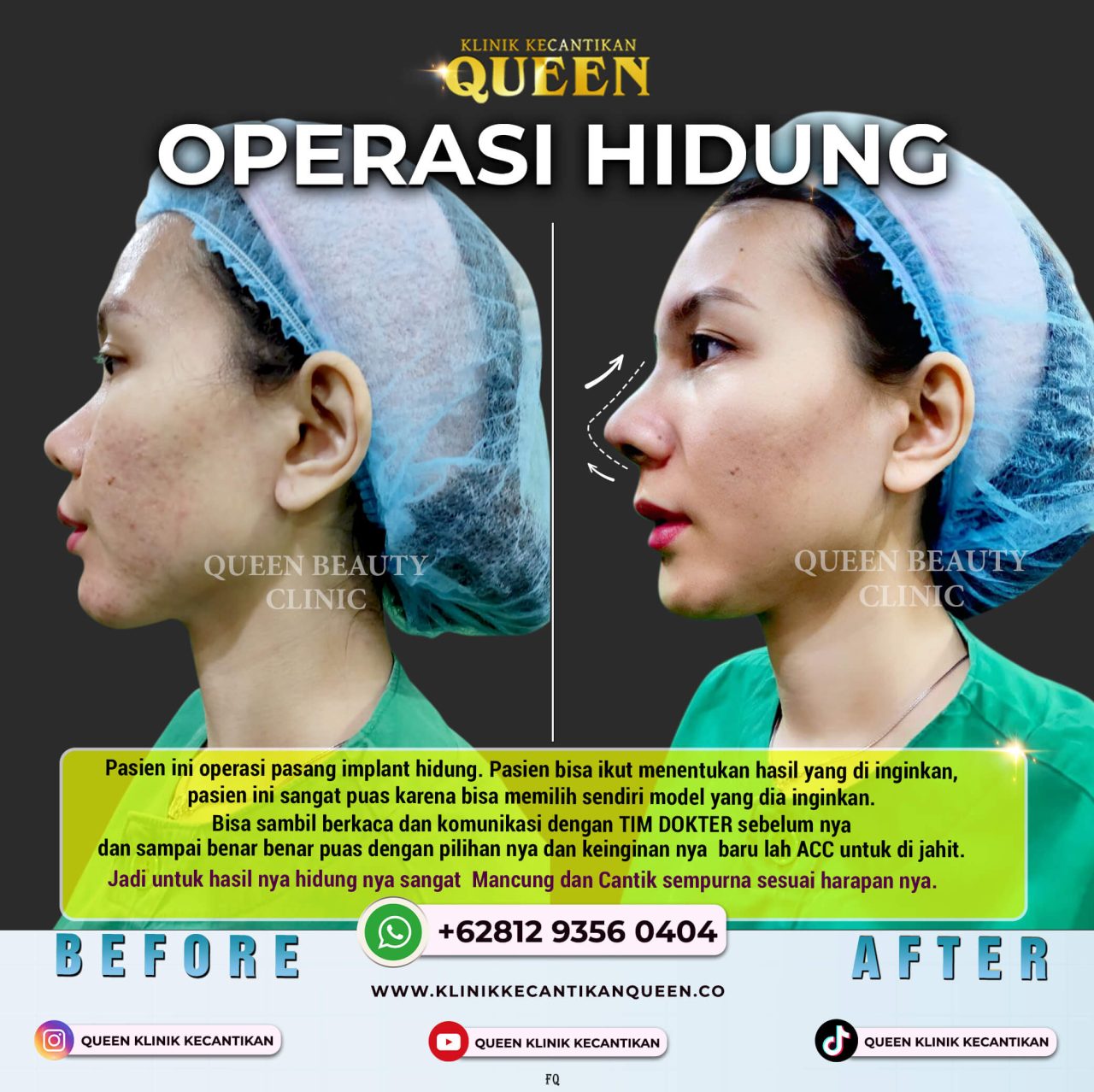 OP IMPLANT HIDUNG