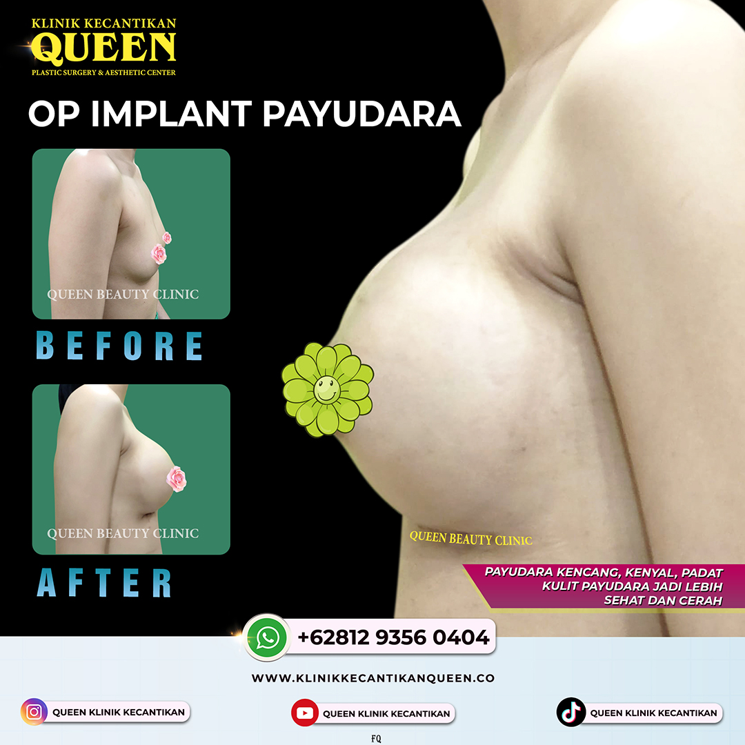 OP-IMPLANT-PAYUDARA