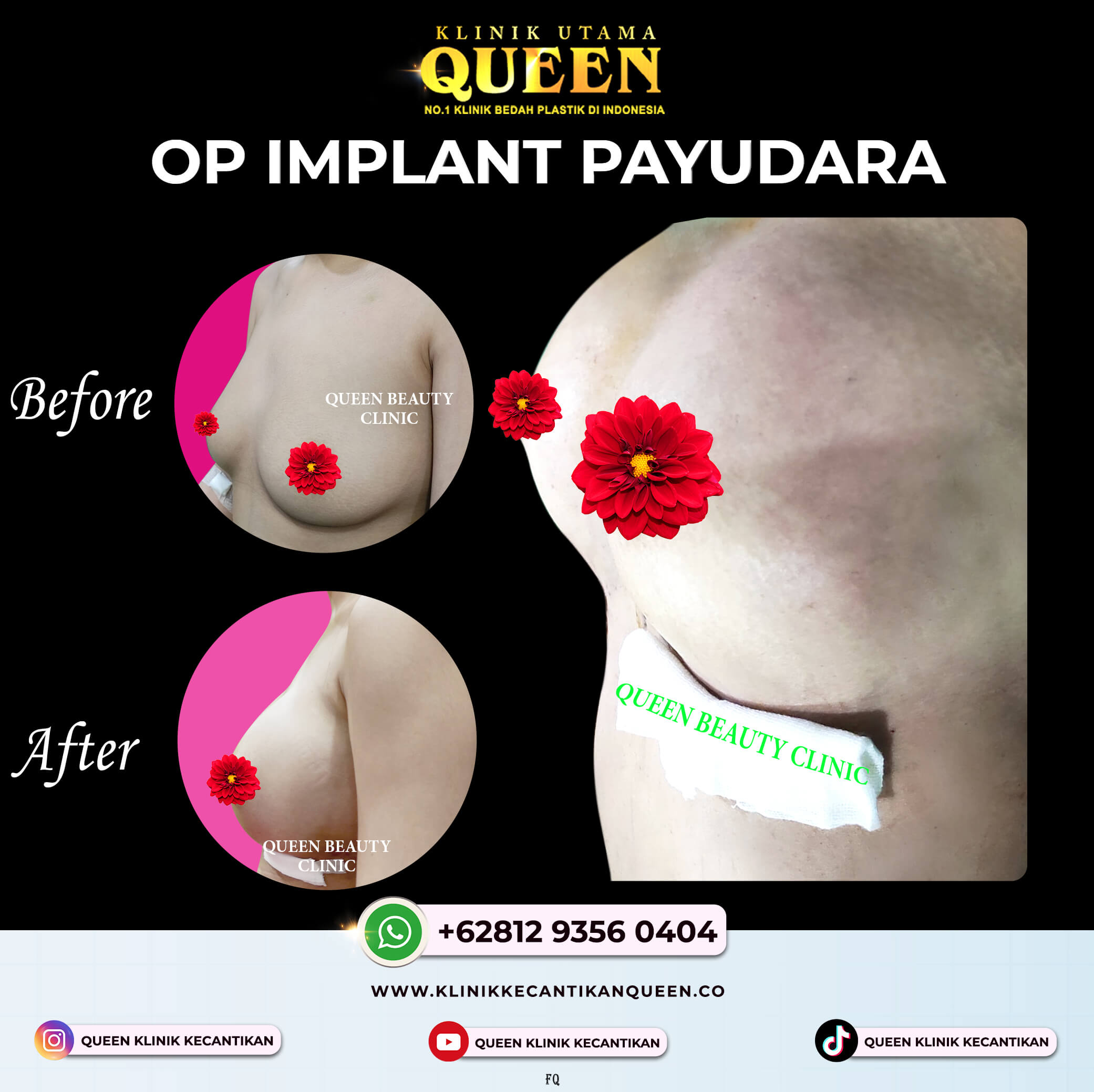 OP IMPLANT PAYUDARA NEW
